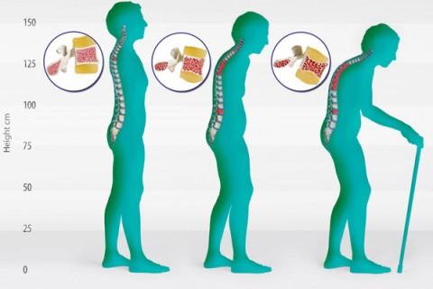 Остеопороз позвоночника
